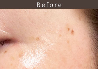 プラズマホワイト Before