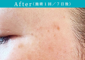 プラズマホワイト After(施術1回/7日後)