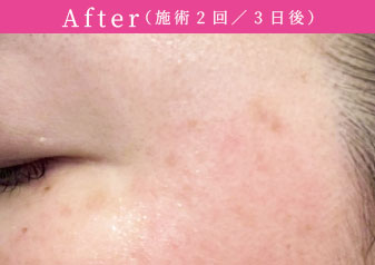 プラズマホワイト After(施術2回/3日後)