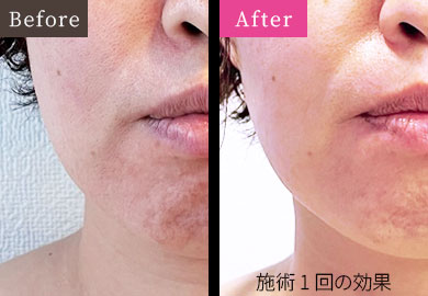 GRAND IPL Before and After