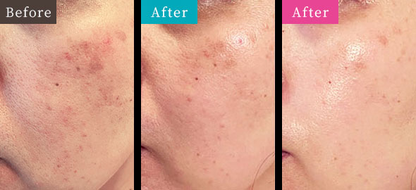 GRAND IPL Before and After