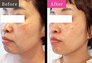 GRAND IPL Before and After